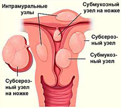 фибромиома матки оперировать или не оперировать