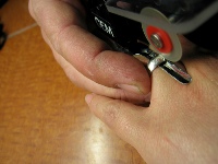 Как снять кольцо если палец сильно отеку