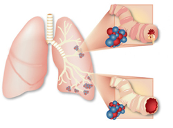 Бронхиальную астму могут вызвать