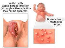 Герпес вирусная инфекция и беременность thumbnail